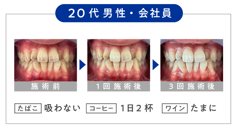 ホワイトニングカフェ効果